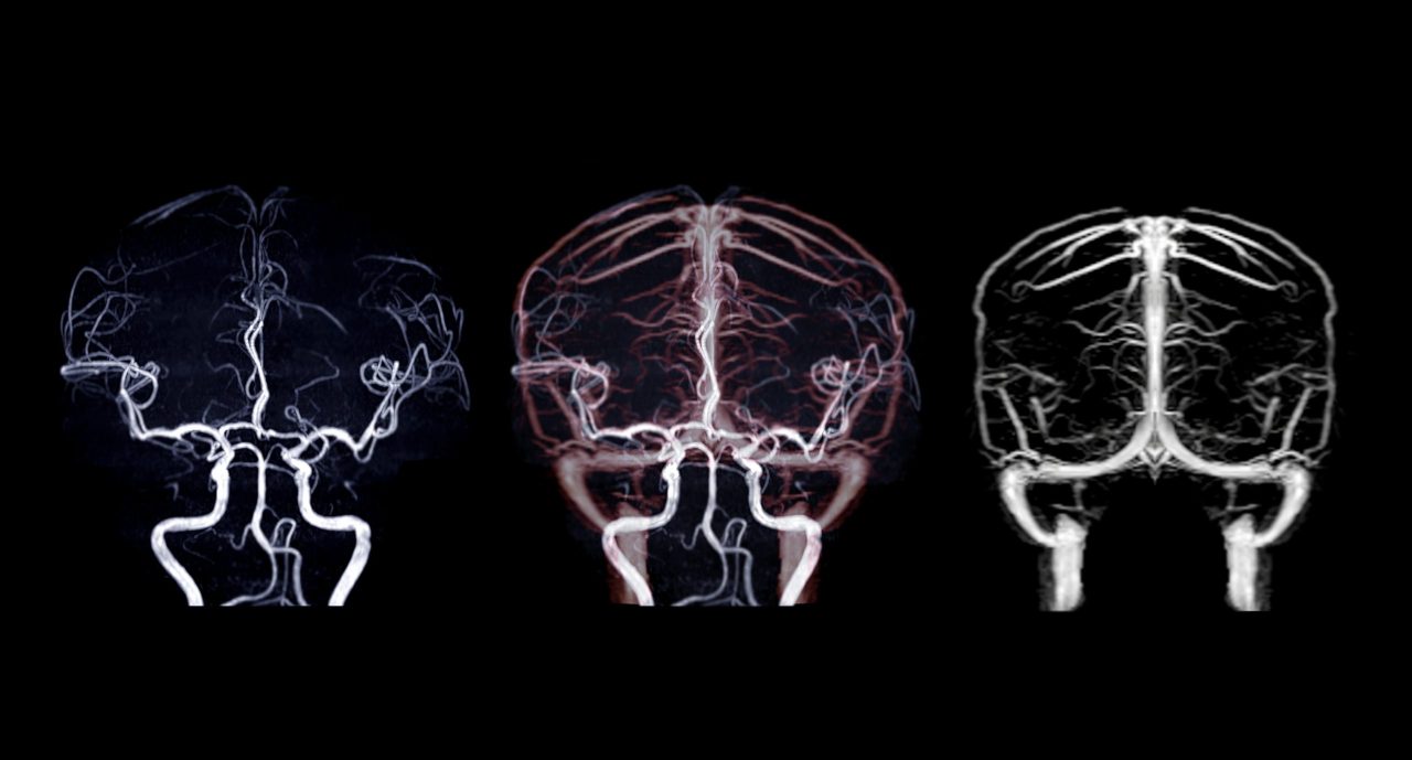 Carotid Stenosis | Champlain Valley Vascular