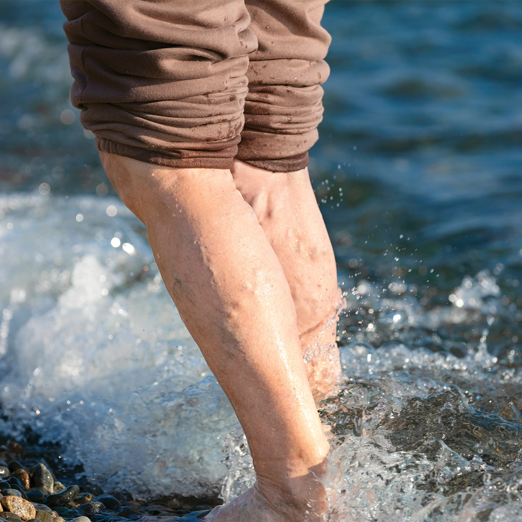 Varicose Vein treatment