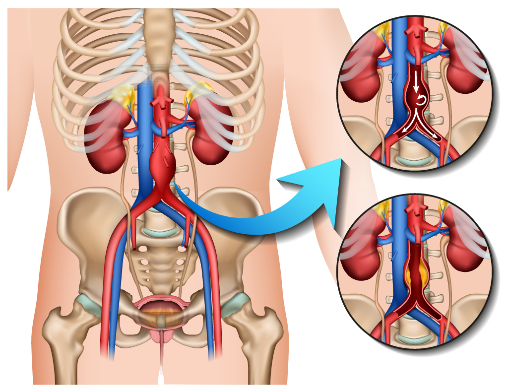 abdominal aortic aneurysm