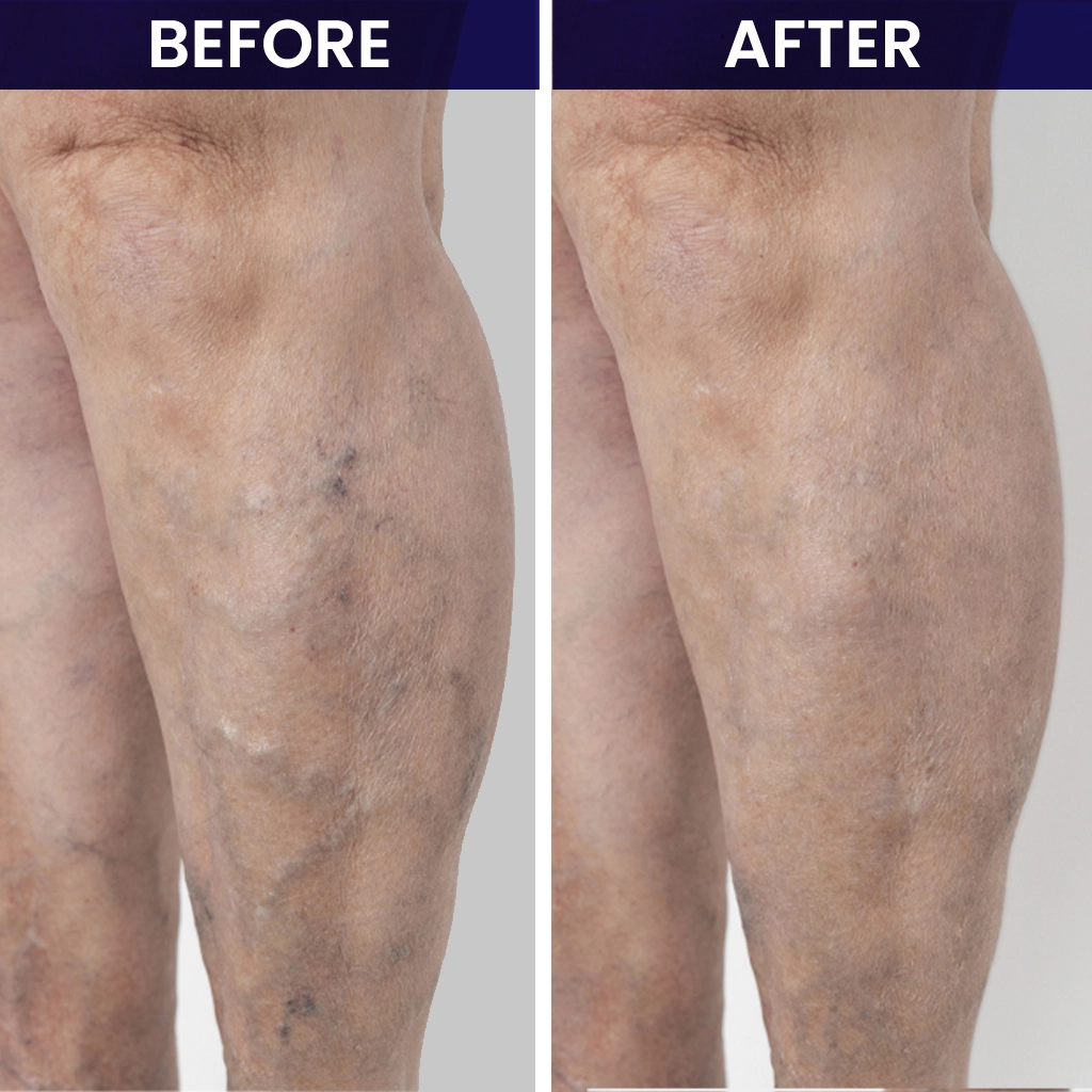 before and after vein treatment