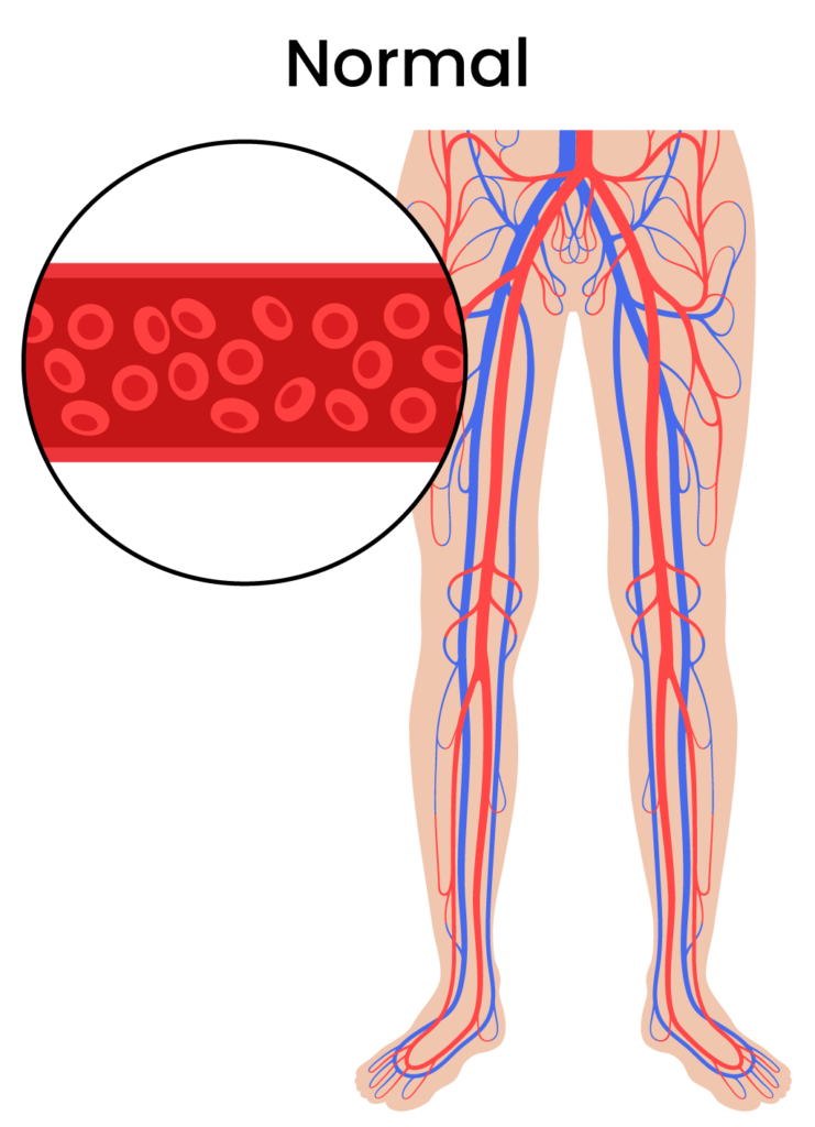 peripheral artery disease healthy leg