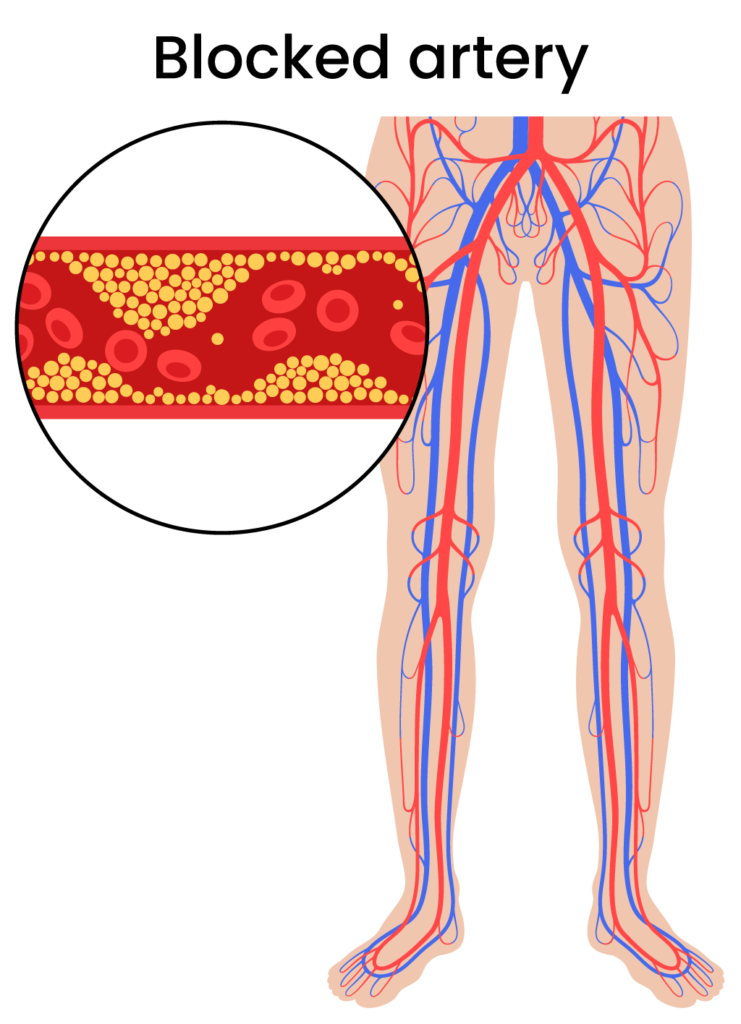 peripheral artery disease