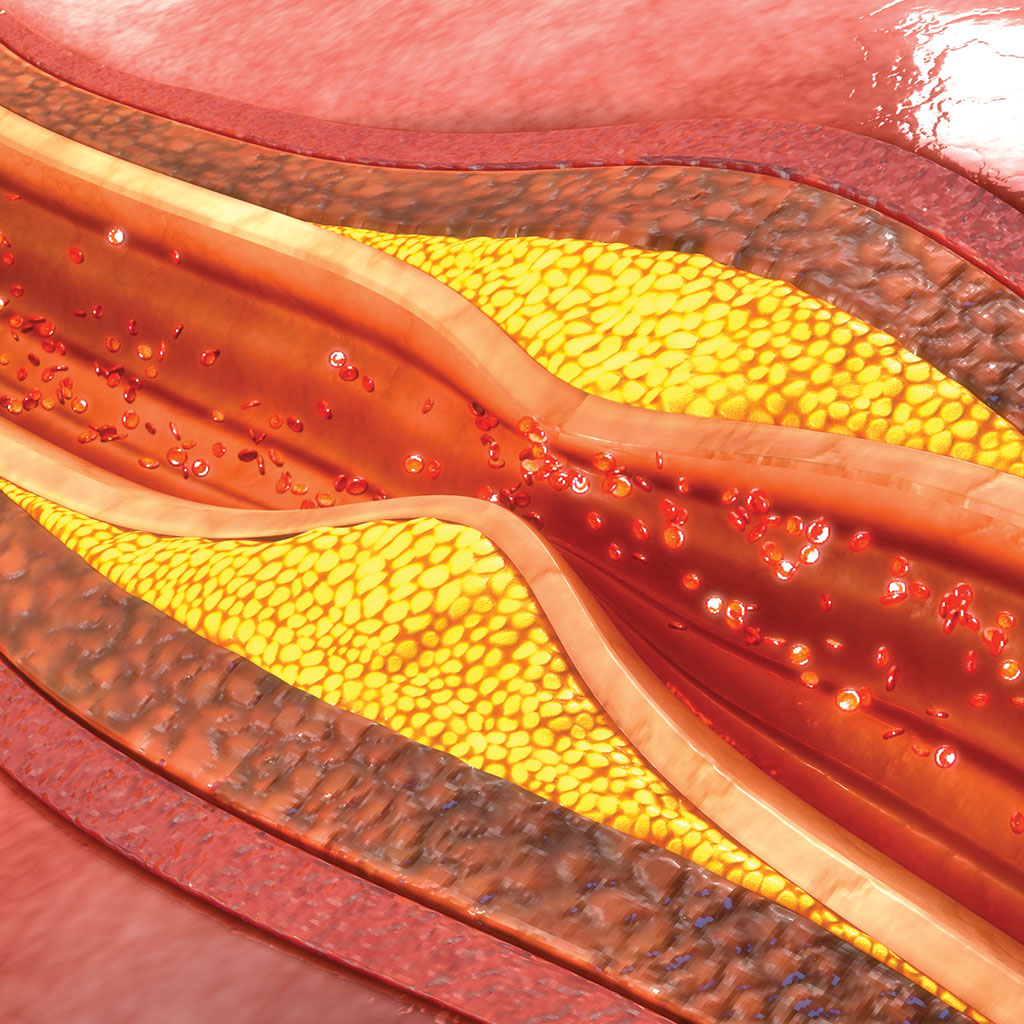 Clogged Artery Illustration