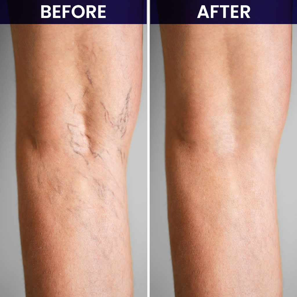 Spider Veins Before and After