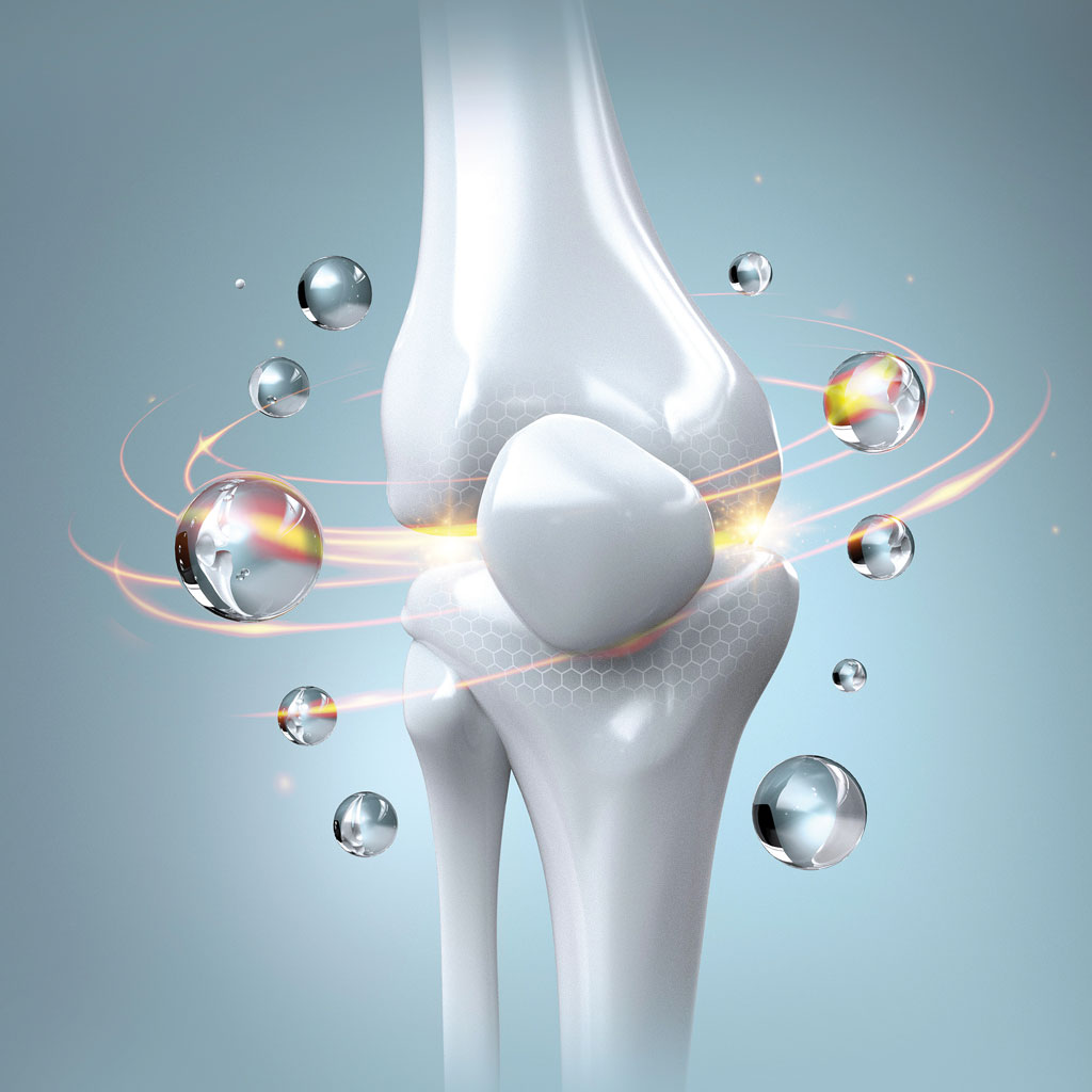 Illustration for Genicular Artery Embolization for Osteoarthritis