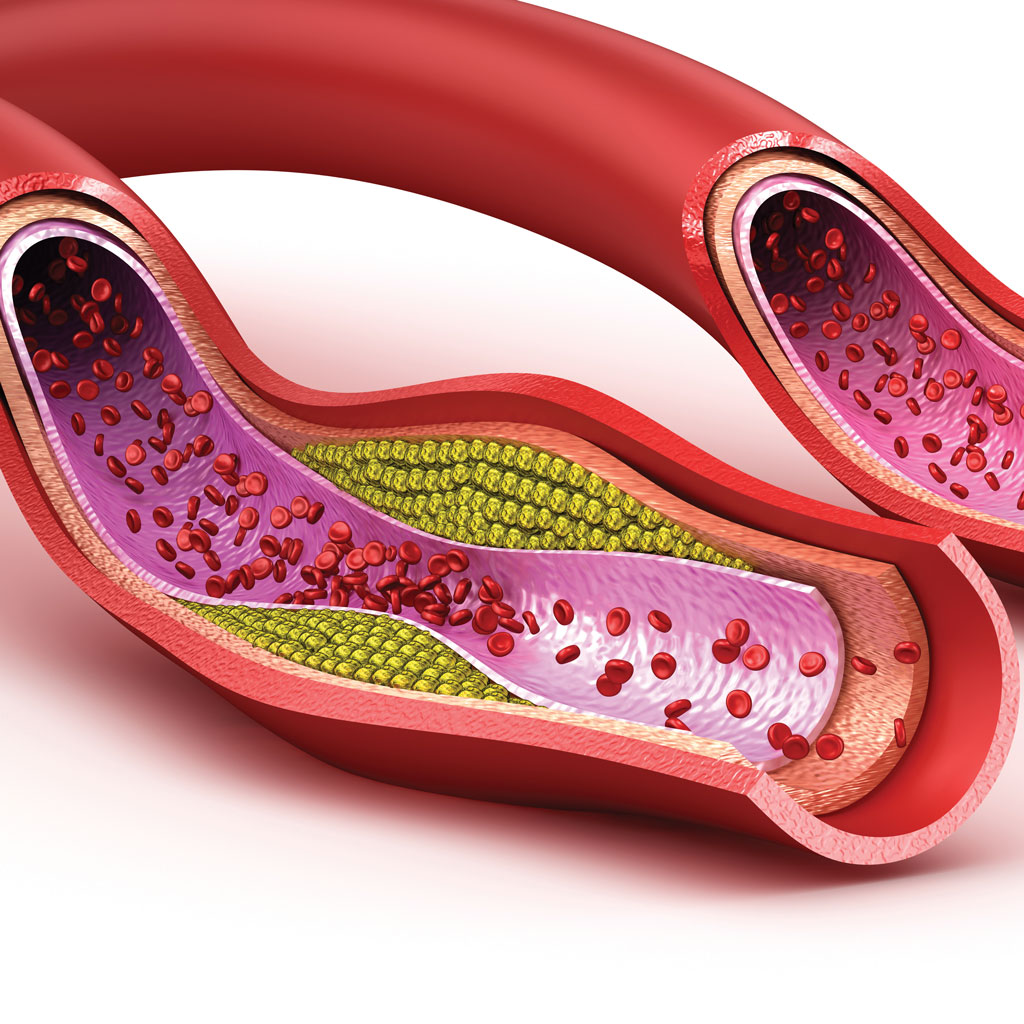 illustration to treat peripheral artery disease
